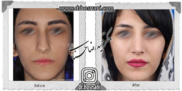  جراحی بینی -1053