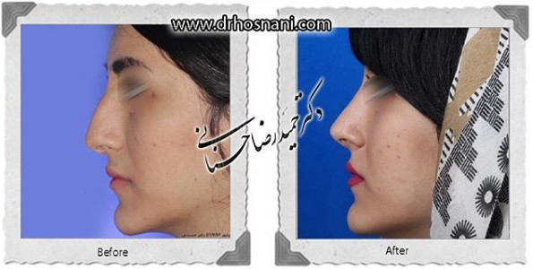  جراحی بینی -1054