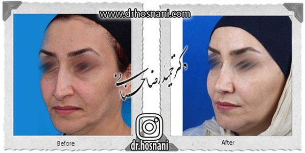  جراحی بینی -1055