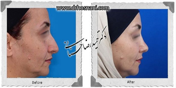  جراحی بینی -1056