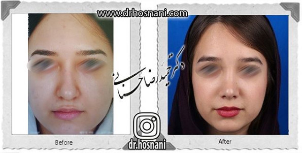  جراحی بینی -1057