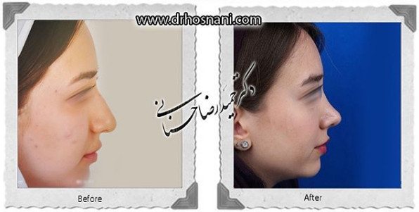  جراحی بینی -1058