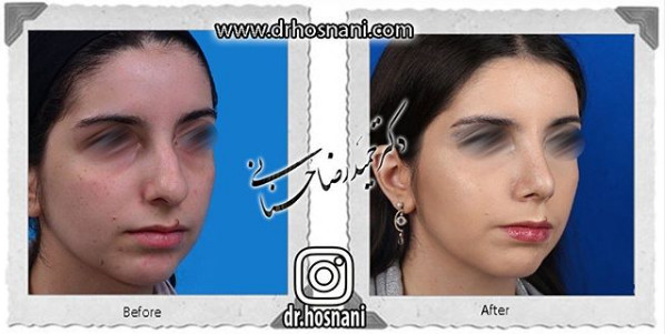  جراحی بینی -1059