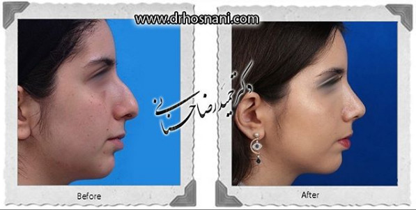  جراحی بینی -1060
