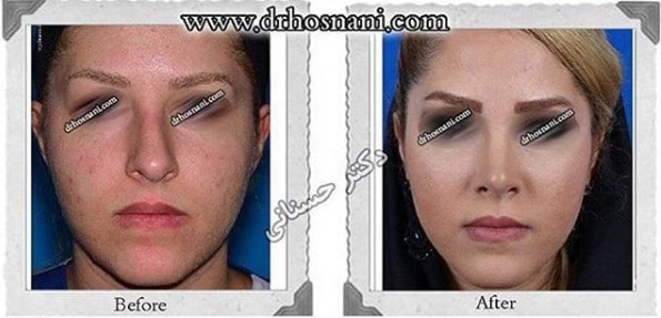 اصلاح انحراف بینی