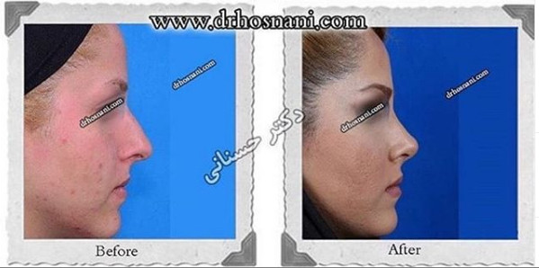 اصلاح انحراف بینی