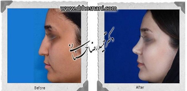  جراحی بینی -1064