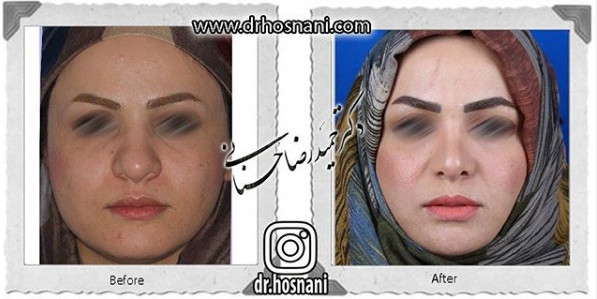  جراحی بینی -1065