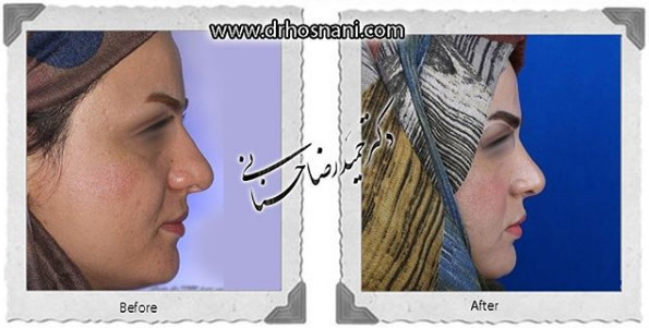  جراحی بینی -1066