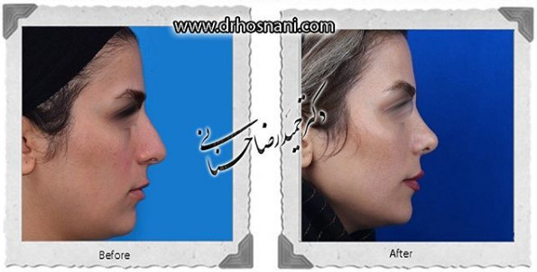  جراحی بینی -1068