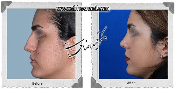  جراحی بینی -1070