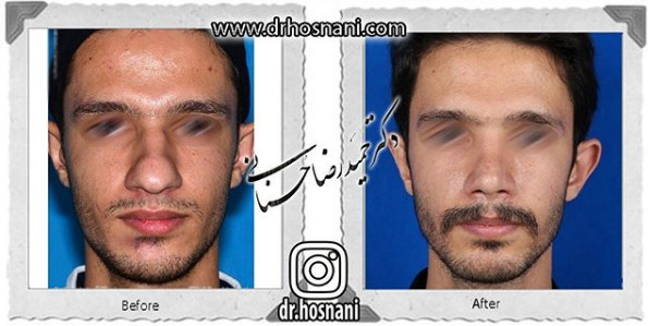  جراحی بینی -1071