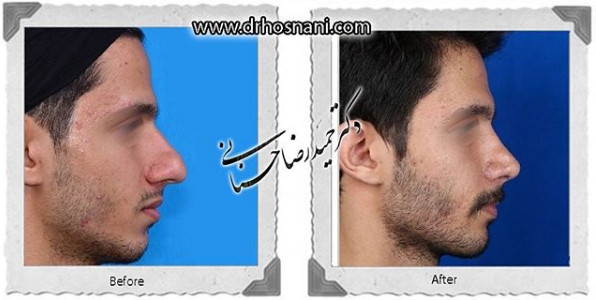  جراحی بینی -1072