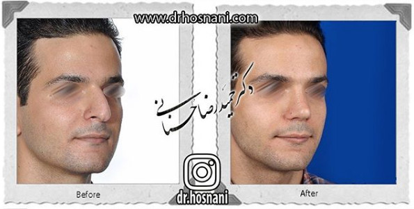  جراحی بینی -1073