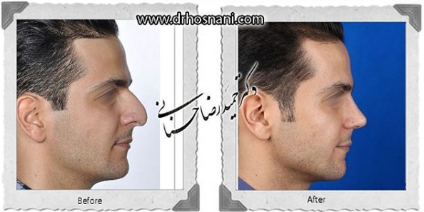  جراحی بینی -1074