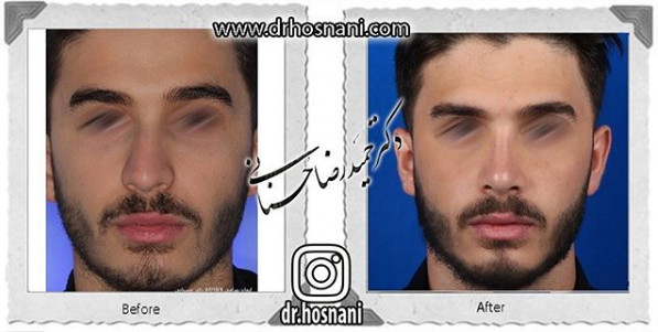  جراحی بینی -1075
