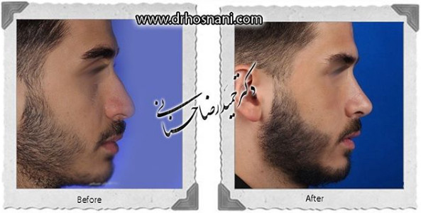  جراحی بینی -1076