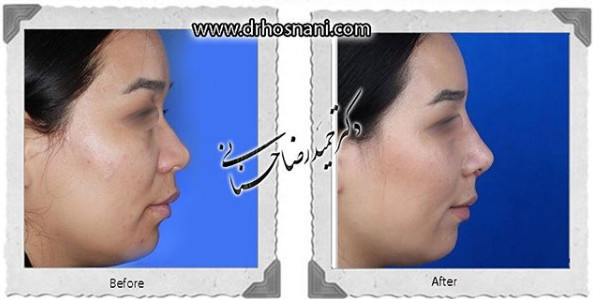 جراحی بینی