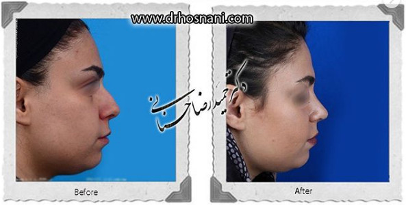  جراحی بینی -1080
