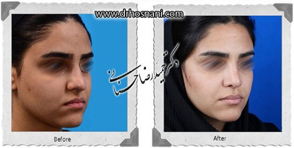  جراحی بینی -1082