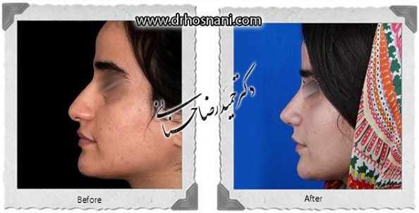  جراحی بینی -1084
