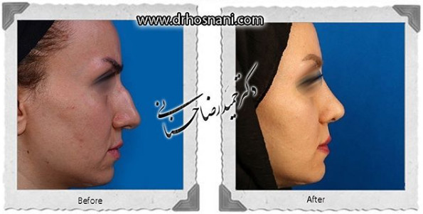  جراحی بینی -1086