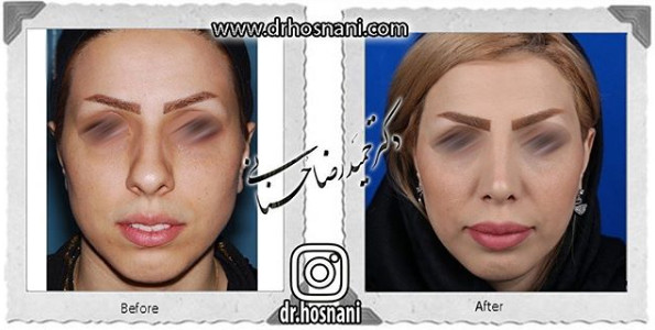 جراحی بینی -1087