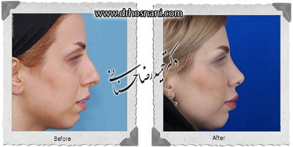  جراحی بینی -1088