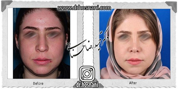  جراحی بینی -1089
