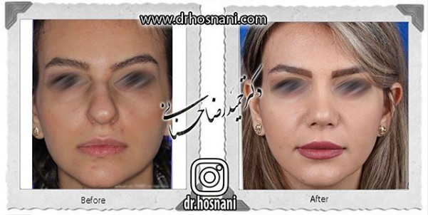  جراحی بینی -1091
