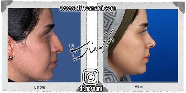  جراحی بینی -1093