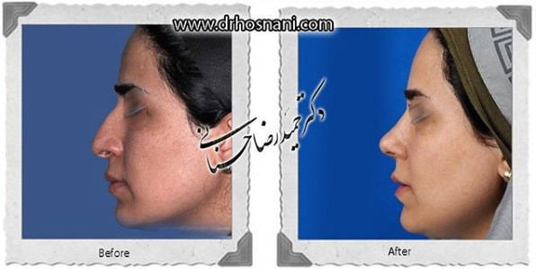  جراحی بینی -1094