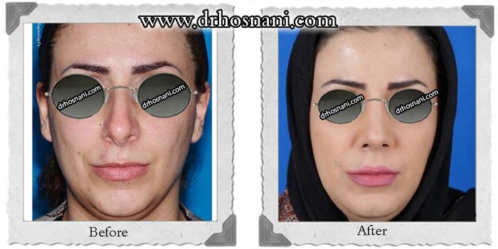 اصلاح انحراف بینی