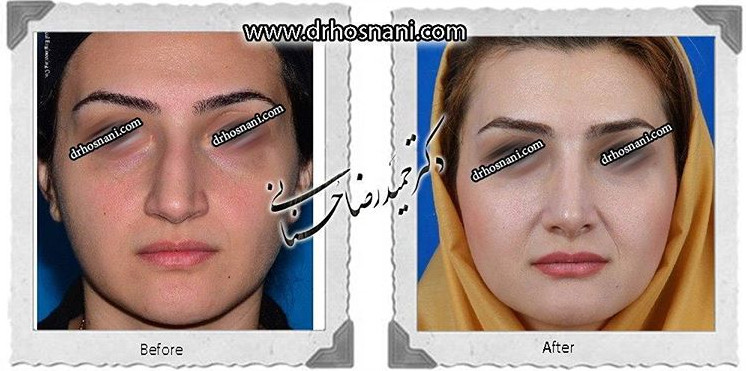 اصلاح انحراف بینی