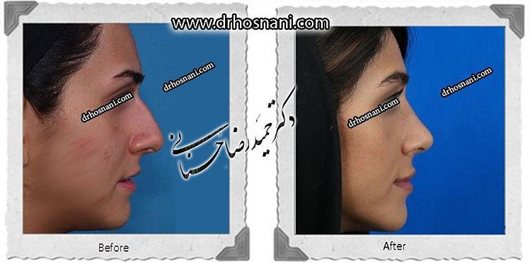 جراحی بینی