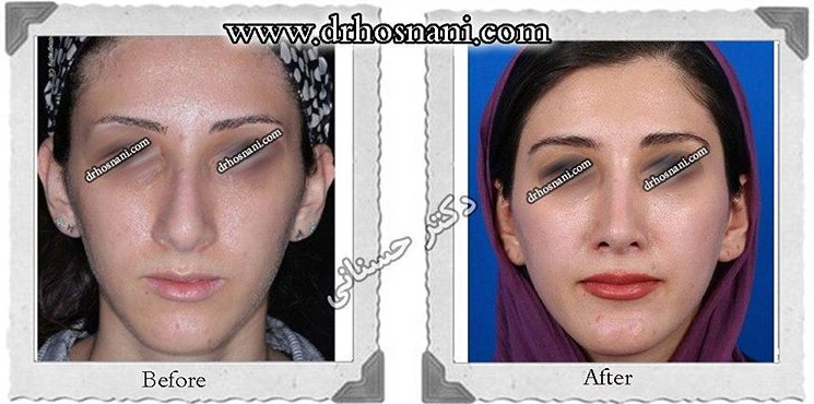 جراحی بینی