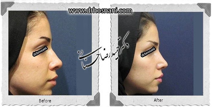 کاهش طول بینی