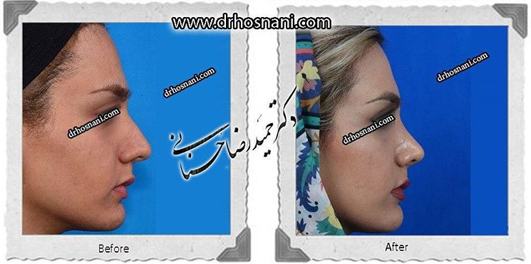 جراحی بینی