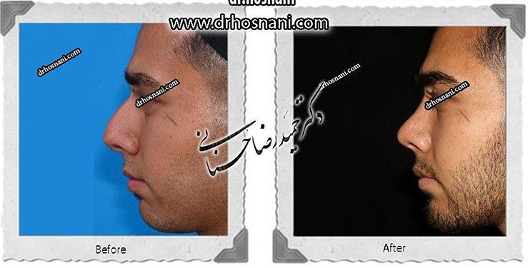 کاهش ارتفاع بینی