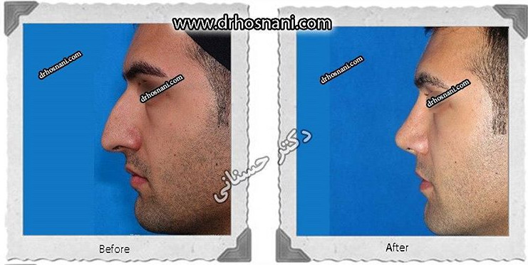جراحی بینی