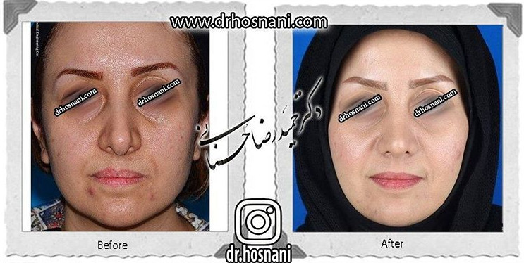جراحی بینی