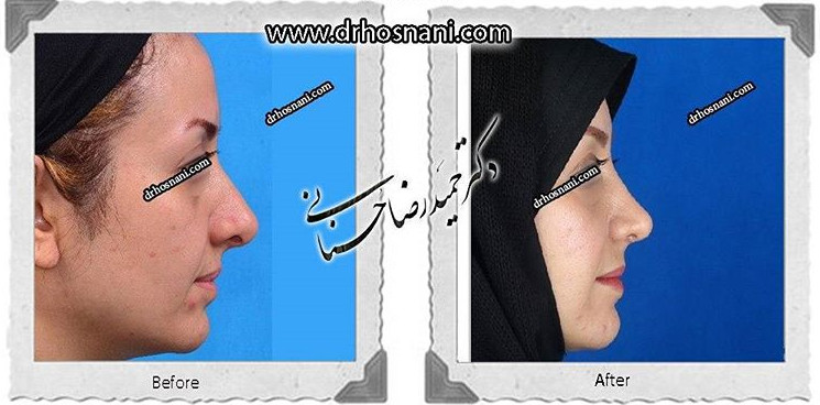 جراحی بینی