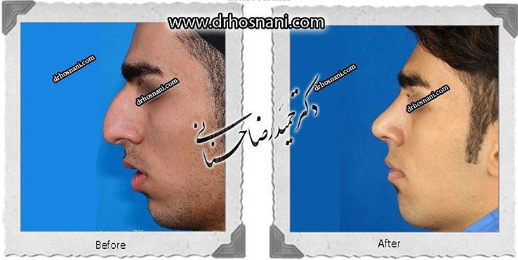 اصلاح انحراف بینی