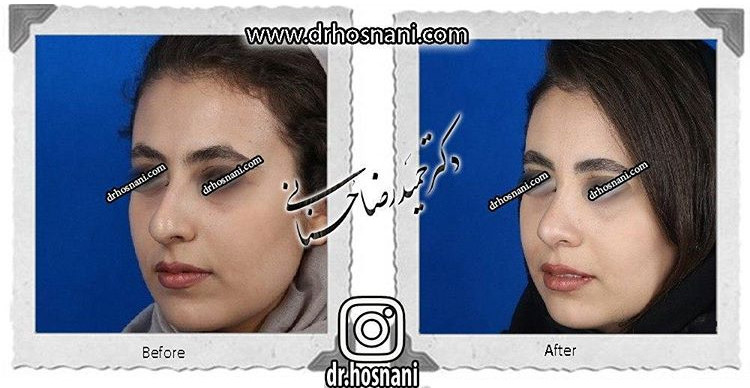 جراحی بینی