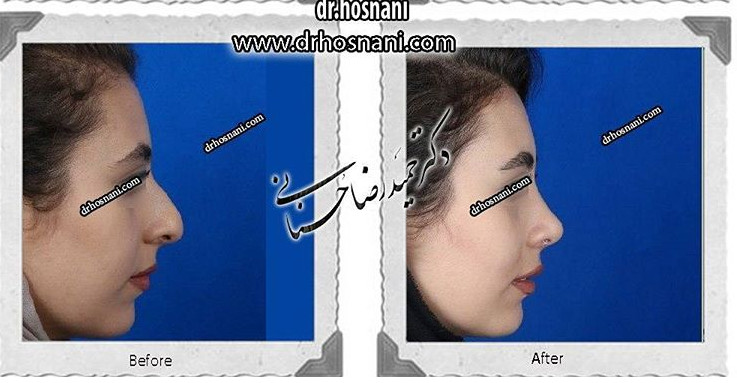  جراحی بینی -572