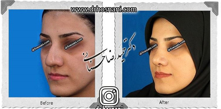  جراحی بینی -574