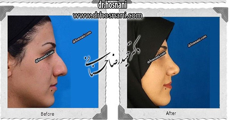  جراحی بینی -575
