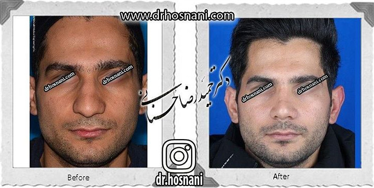 اصلاح انحراف بینی