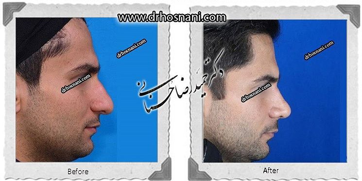 اصلاح انحراف بینی