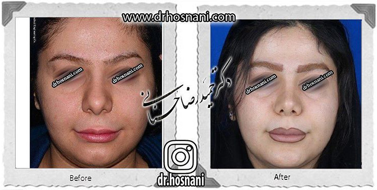 اصلاح انحراف بینی